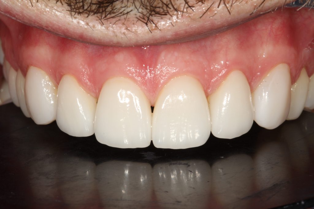 St Andrews Dental Care | Dental Veneers After Veneers