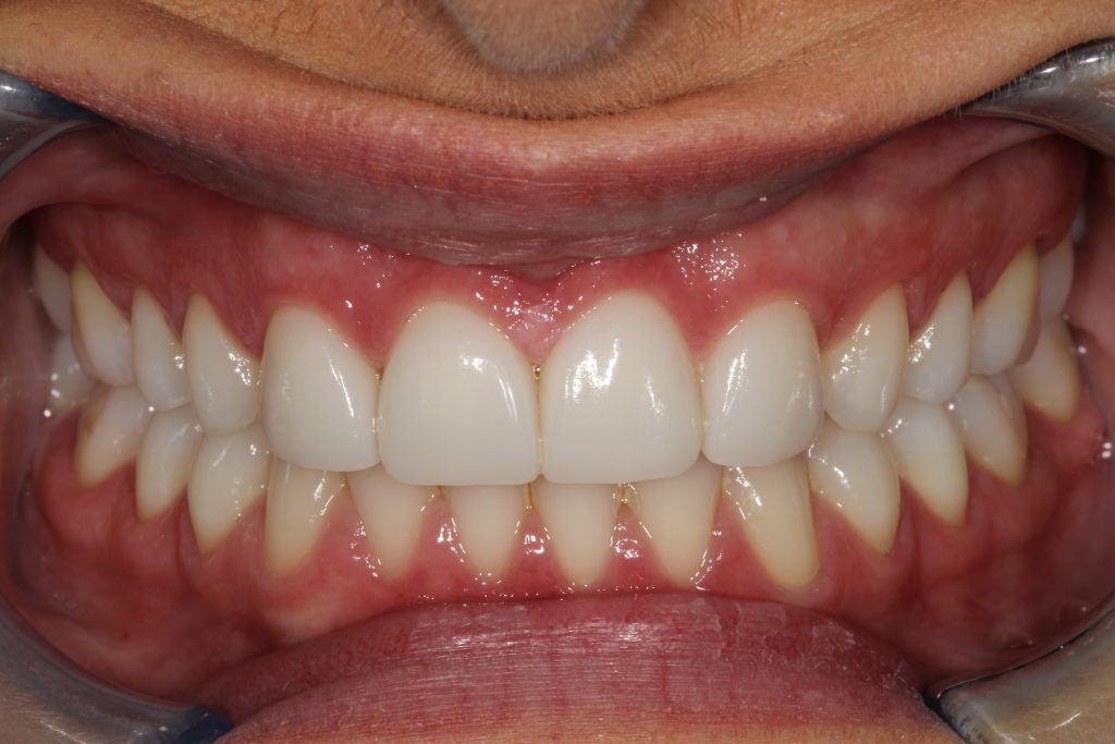 St Andrews Dental Care | Dental Veneers After Veneers