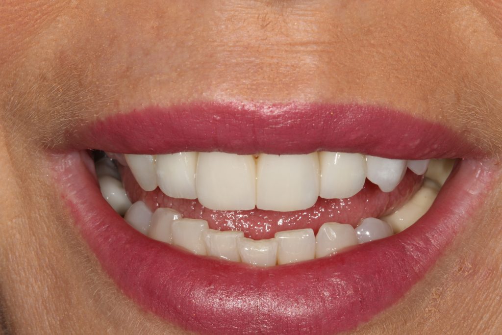 St Andrews Dental Care | Dental Veneers After Veneers