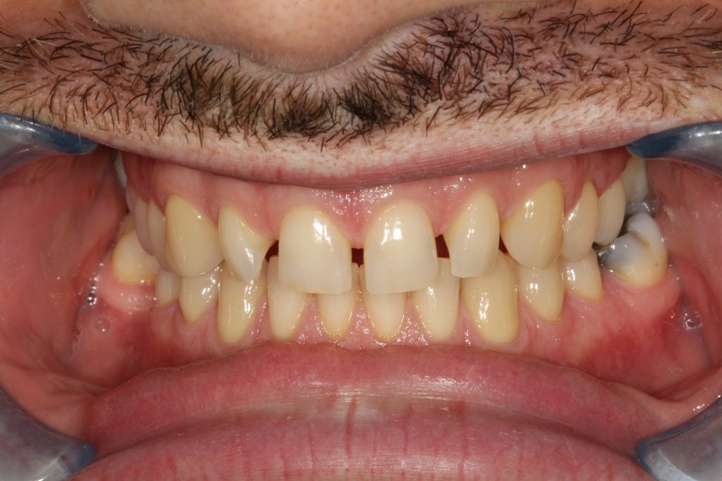 St Andrews Dental Care | Dental Veneers Before Veneers
