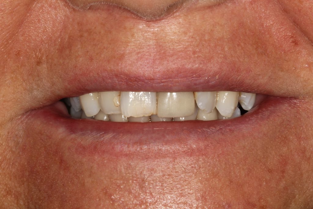 St Andrews Dental Care | Dental Veneers Before Veneers