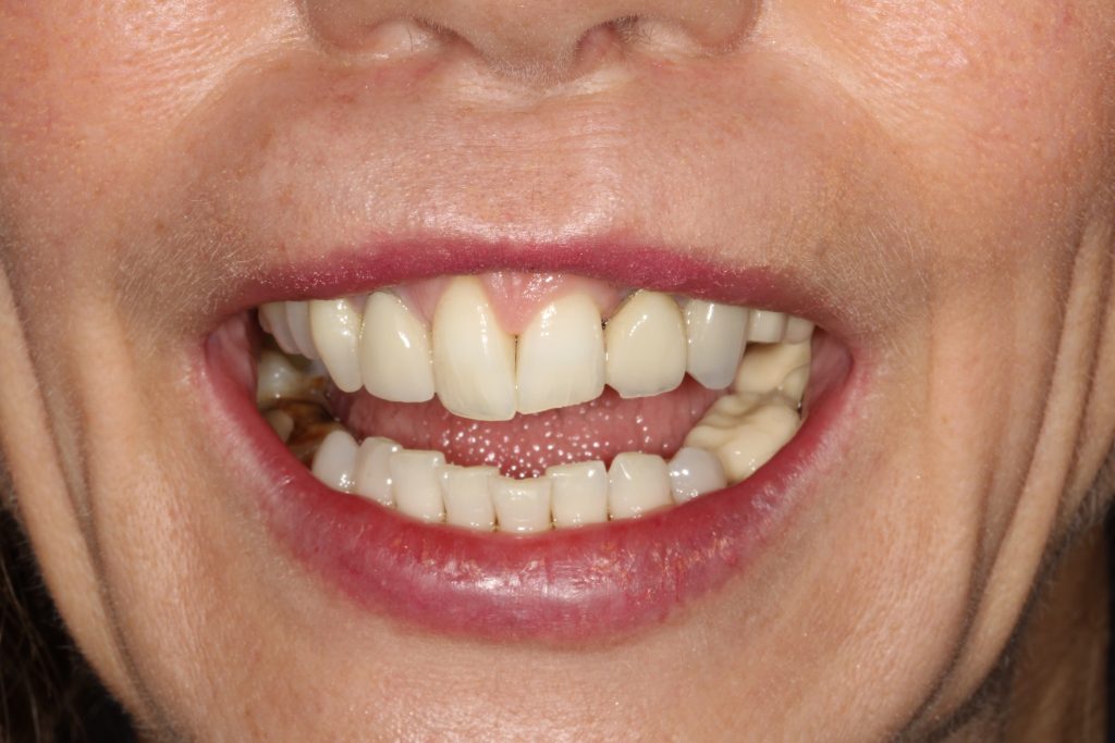 St Andrews Dental Care | Dental Veneers Before Veneers