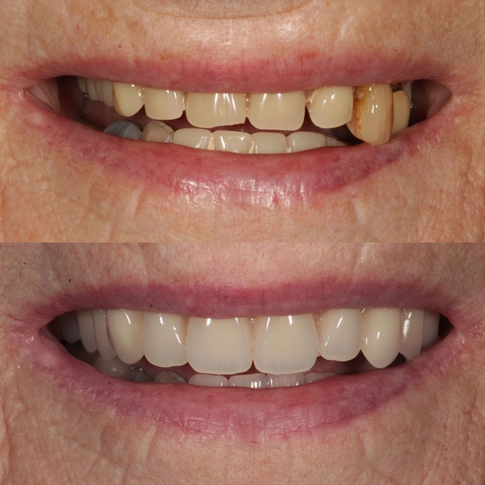 St Andrews Dental Care | Request A Complimentary Consultation Before and after treatment at St Andrews Dental Care in Fife