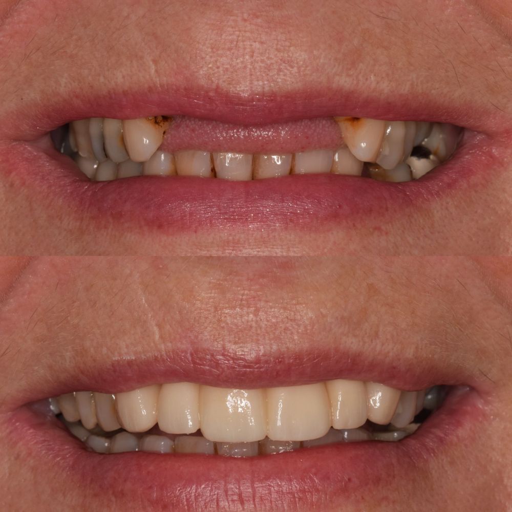 St Andrews Dental Care | Request A Complimentary Consultation Before and after treatment at St Andrews Dental Care in Fife