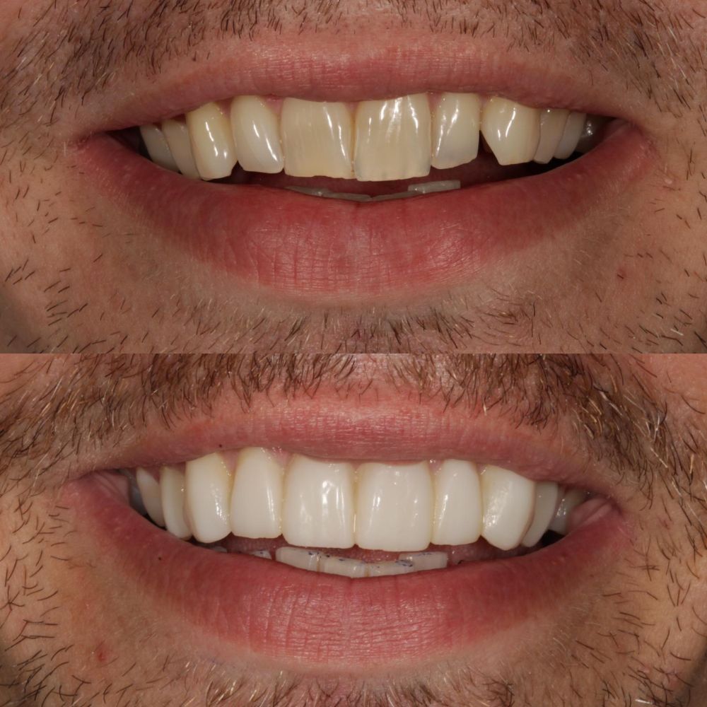 St Andrews Dental Care | Request A Complimentary Consultation Before and after treatment at St Andrews Dental Care in Fife