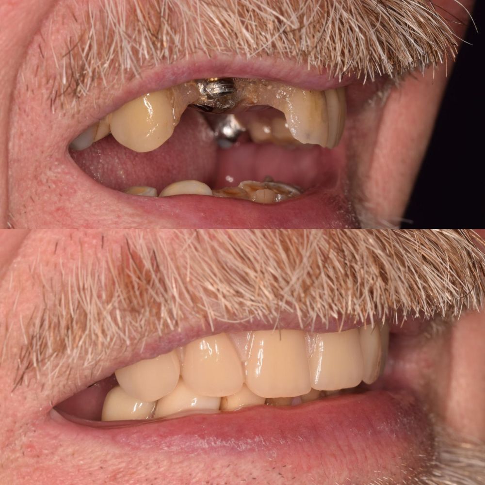 St Andrews Dental Care | Request A Complimentary Consultation Before and after treatment at St Andrews Dental Care in Fife