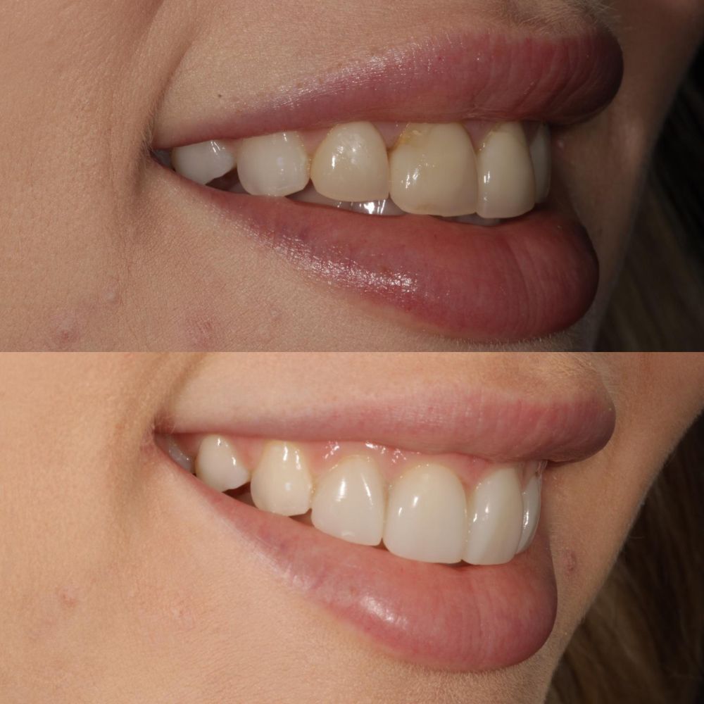 St Andrews Dental Care | Request A Complimentary Consultation Before and after treatment at St Andrews Dental Care in Fife