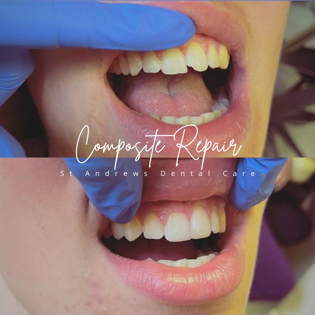 St Andrews Dental Care | Smile Makeovers Before and after treatment at St Andrews Dental Care