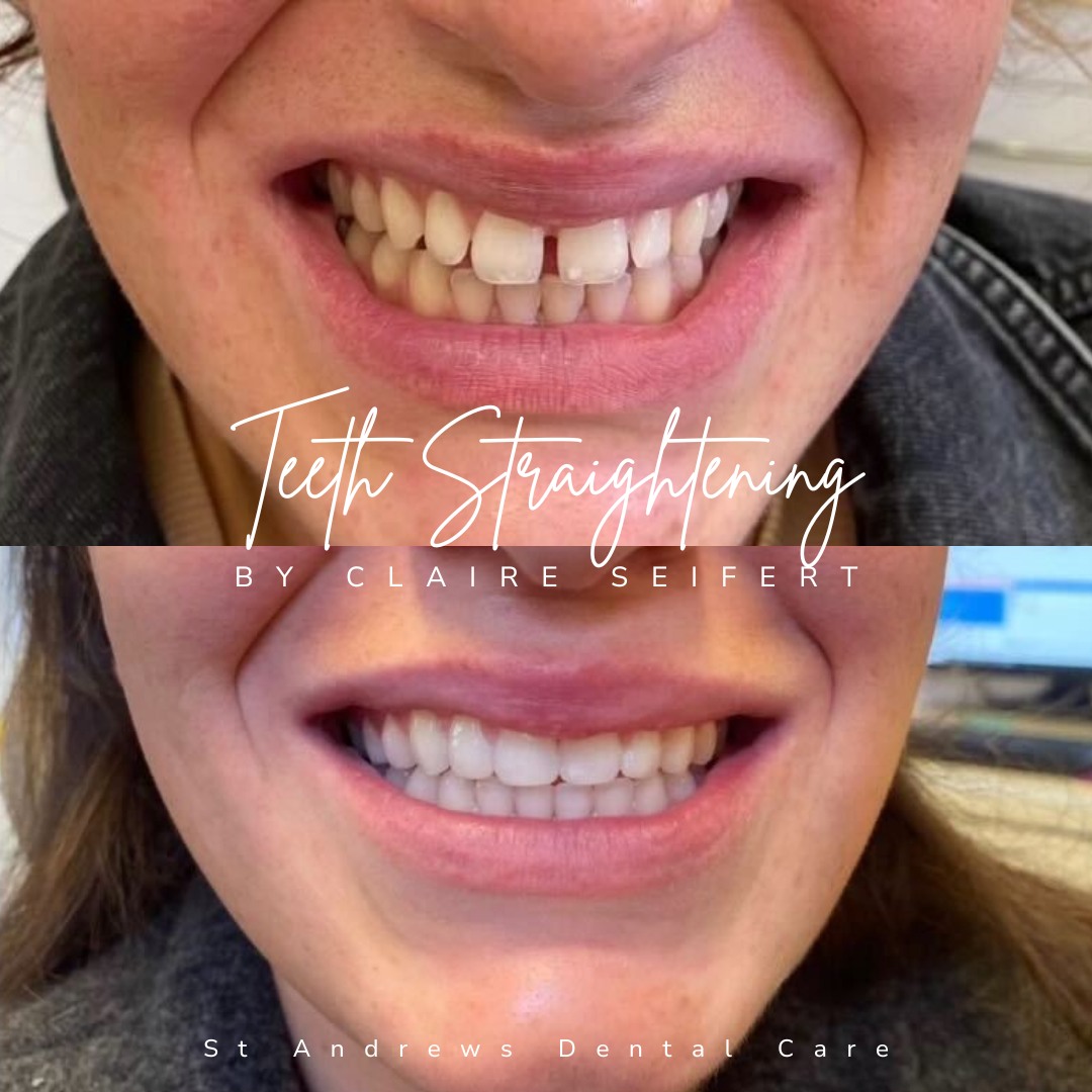 St Andrews Dental Care | Smile Makeovers Before and after treatment at St Andrews Dental Care