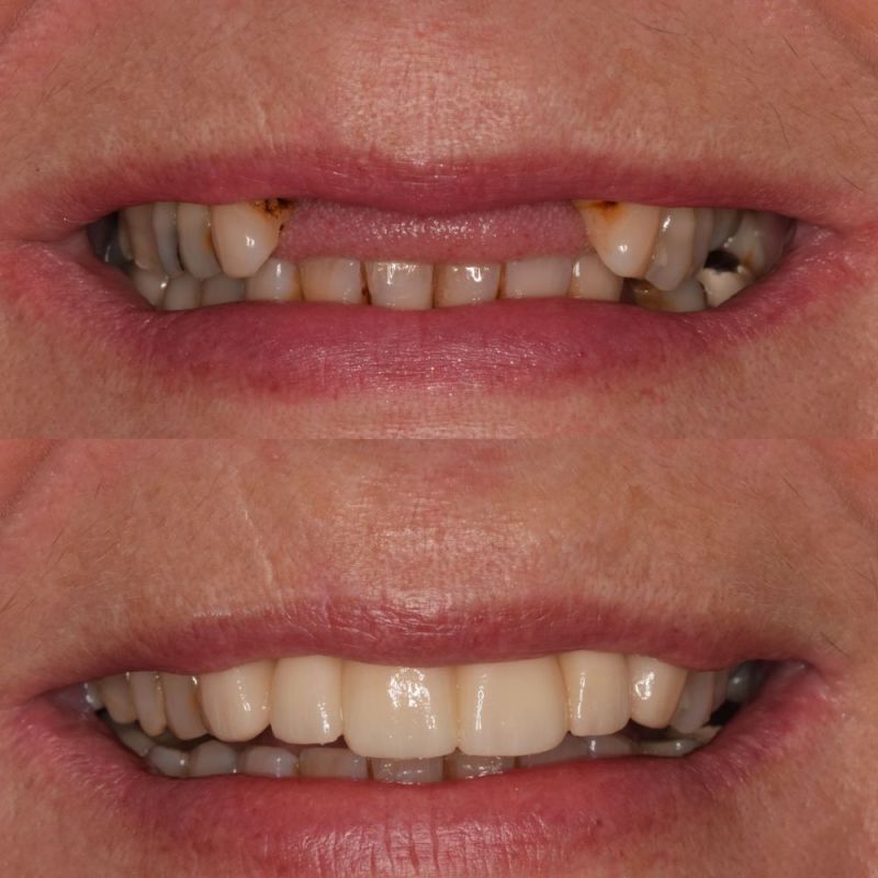 St Andrews Dental Care | Dental Implants Fife Replace Missing Teeth St Andrews Dental Care | Dental Implants Fife Replace Missing Teeth