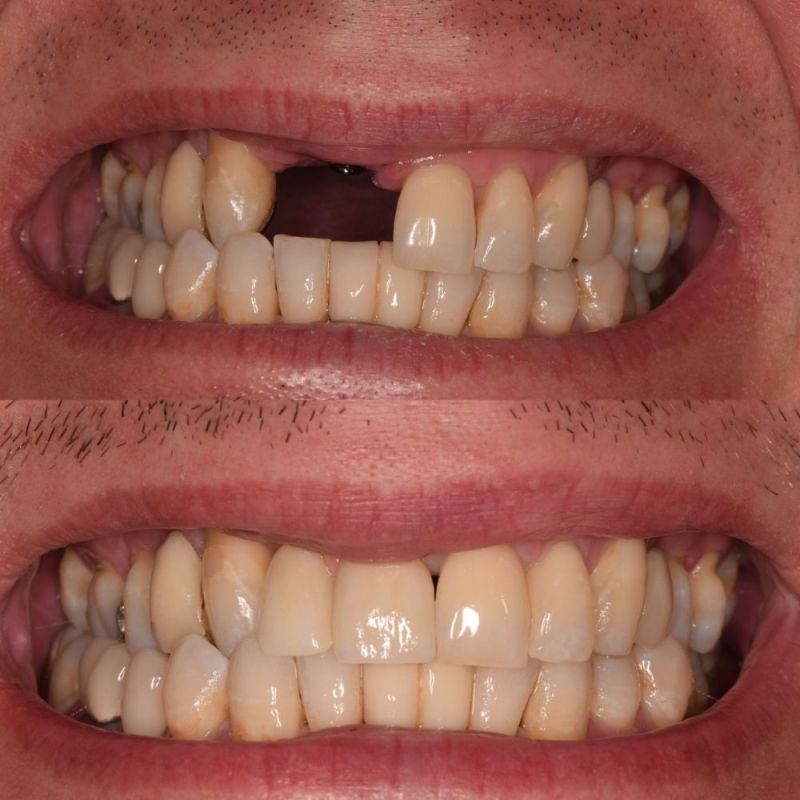 St Andrews Dental Care | Dental Implants Fife Replace Missing Teeth St Andrews Dental Care | Dental Implants Fife Replace Missing Teeth