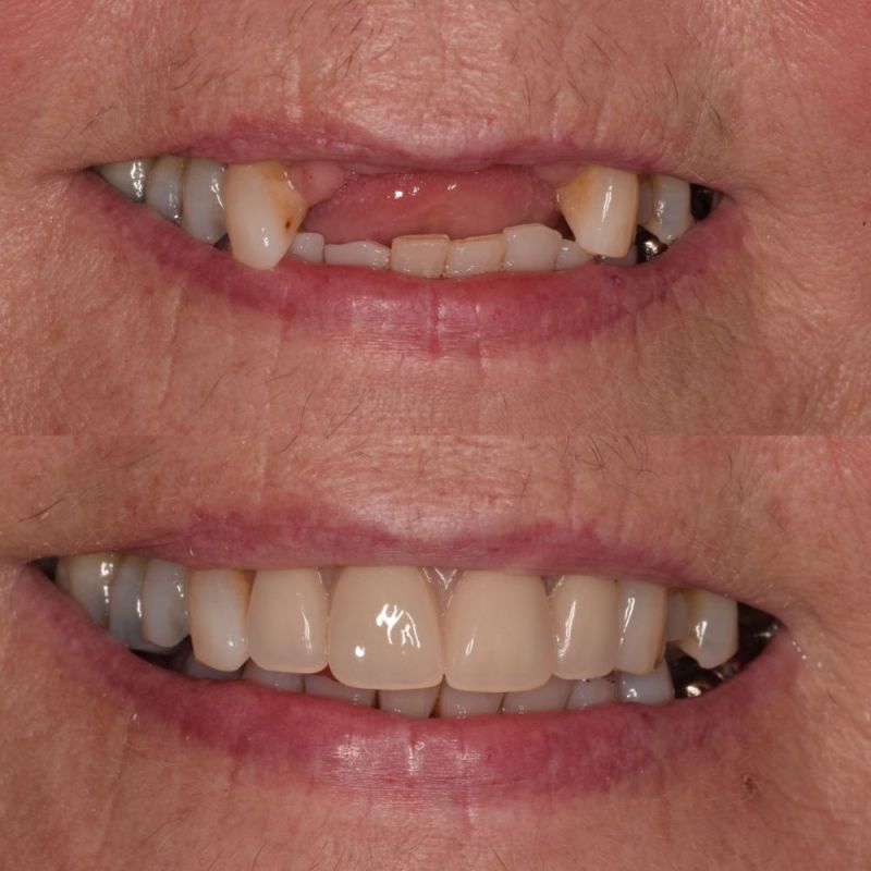 St Andrews Dental Care | Dental Implants Fife Replace Missing Teeth St Andrews Dental Care | Dental Implants Fife Replace Missing Teeth